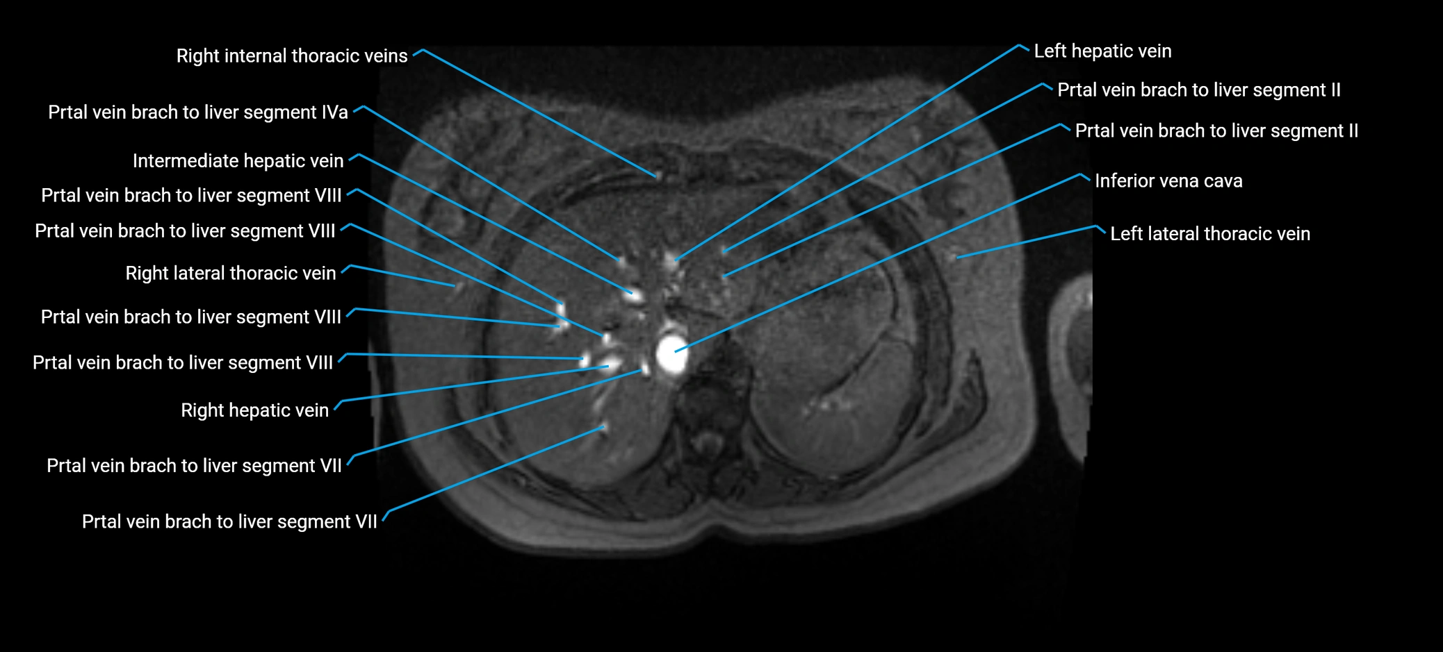 MRV abdomen pelvis & lower limb axial cross sectional anatomy labelled MRI image 27 (2).webp